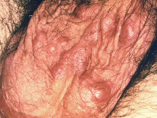Ngứa, mọc mụn nhỏ là triệu chứng điển hình của bệnh ghẻ ở cơ quan sinh dục nam